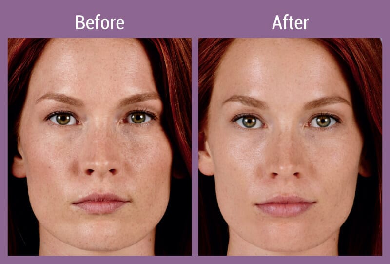 juvederm-ultraxc-beforeafter-1