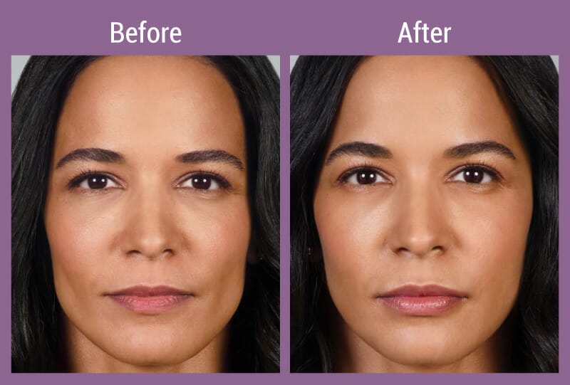 juvederm-ultraxc-beforeafter-2