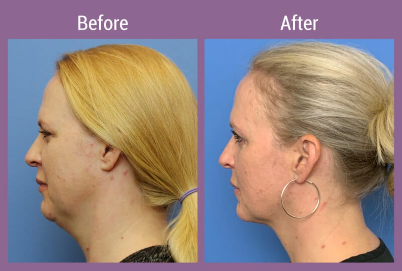 kybella-new-beforeafter-1