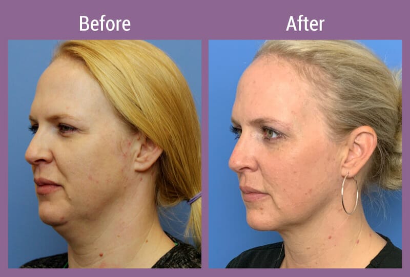 kybella-new-beforeafter-2