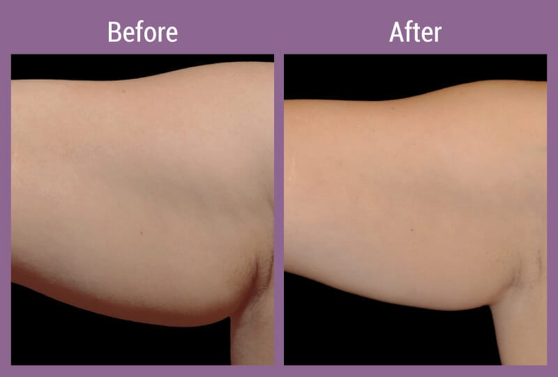 coolsculpting-beforeafter-1