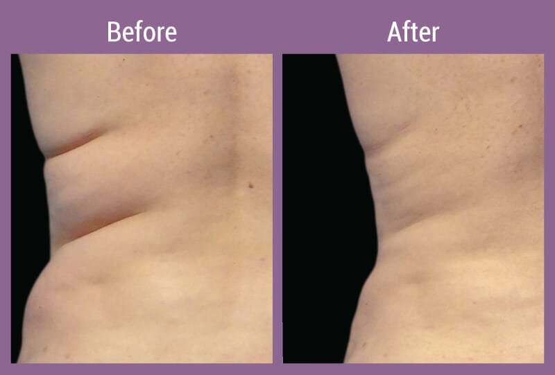 coolsculpting-beforeafter-2