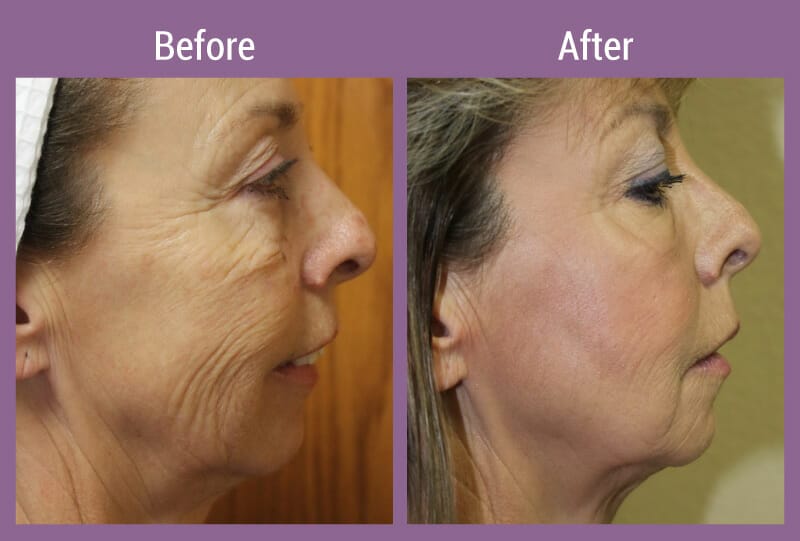 fraxel-before-after-allura-clinic