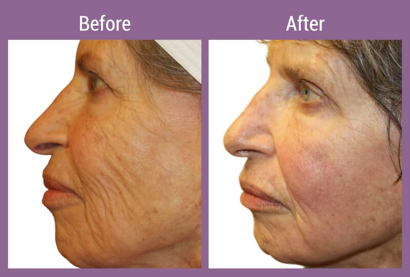 allura-before-after-fraxel-2