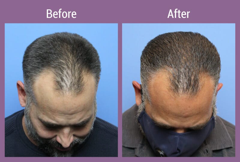 allura-before-after-hair-restore-men-1