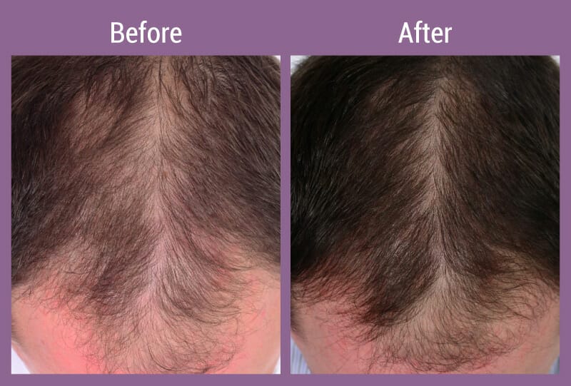 allura-before-after-hair-restore-men-2