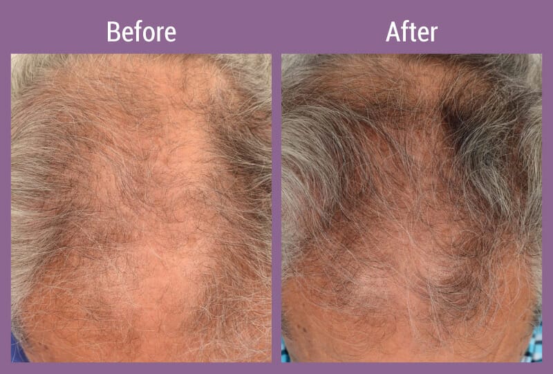 allura-before-after-hair-restore-men-3