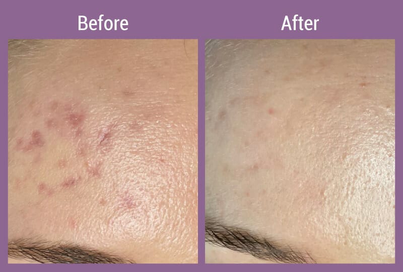 allura-before-after-microneedling-1