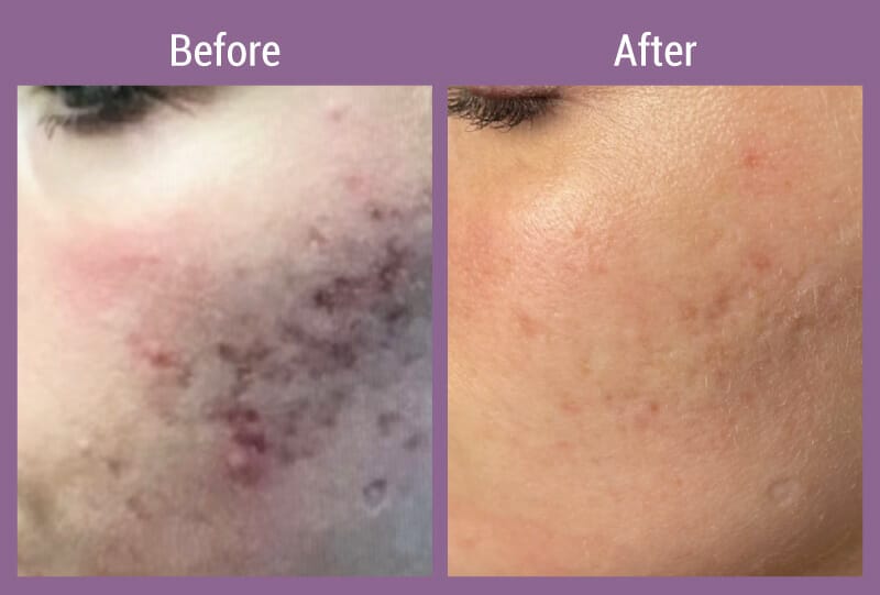 allura-before-after-microneedling-2