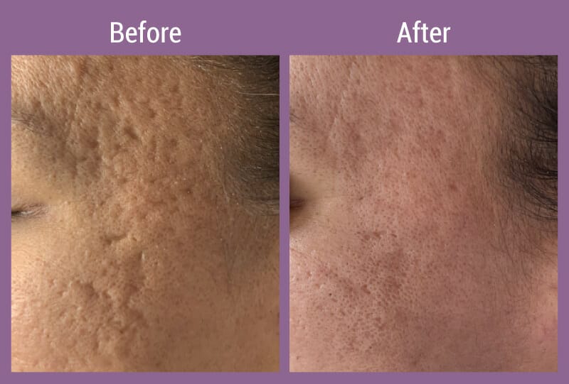 allura-before-after-microneedling-3