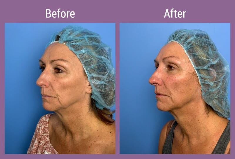 allura-before-after-novathreads-4