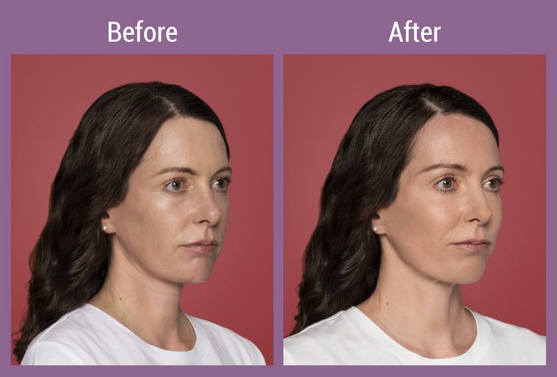 allura-before-after-restylane-1