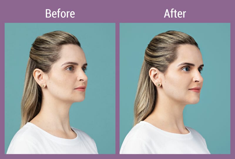 allura-before-after-restylane-2