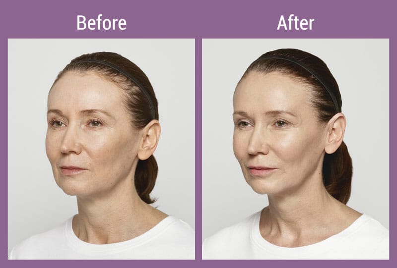 allura-before-after-restylane-5