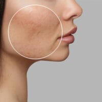 acne-scarring-treatment-allura-clinic-fort-collins