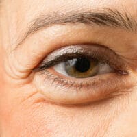 eye-bag-treatment-allura-clinic-fort-collins