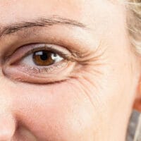 eye-wrinkles-allura